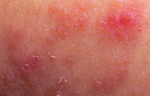 Inflamed and red skin.