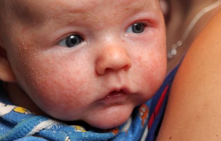 Babyface with flaky reddish skin.