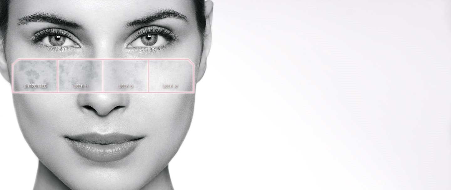 Development of hyperpigmenation during treatment on female skin
