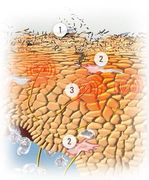 Illustration of skin with symptoms of Atopic Dermatitis.