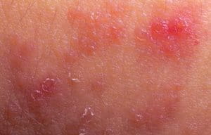 Red and flaky looking skin.